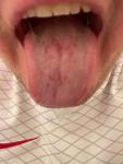 Красные язвочки в полости рта фото 1