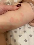 Аллергия или дерматит у ребёнка в два года фото 1