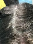 Псориаз волосистости части головы фото 3