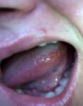 Воспаление языка по бокам фото 1