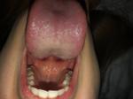 Воспаление сосочков на корне языка фото 1