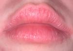 Красная кайма губ, сухость, жжение, мелкие пузыри фото 1