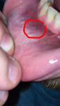Уплотнённое образование на слизистой нижней губы фото 2
