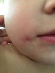 Уплотнение в щеке у ребёнка после внутреннего повреждения слизистой фото 1
