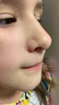 Высыпания на лице у ребенка 8 лет фото 2