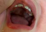 У ребёнка нет эмали на зубе почернел зуб фото 1