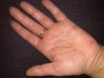 Дерматит кистей рук (причины не ясны) фото 1
