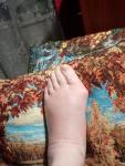 Опухоль и краснота на одной ноге фото 2