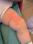Аллергия у ребёнка в виде красных полос фото 5