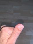 Ногтевая меланома или нет? Полоска на ногтевой пластине фото 1