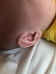 Поломанное ушко у новорождённого фото 2