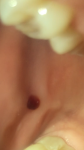 Красное кровяное пятно в полости рта фото 1