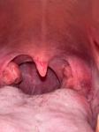 Ком в горле воспаление миндалин фото 1