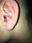 Прыщ в ушной полости фото 1