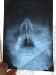 Рентген пазух носа фото 2