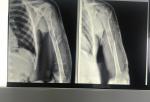 Перелом плечевой кости на фоне опухоли фото 3