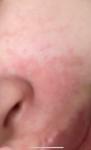 Сыпь после увеличения губ фото 1