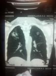 Подозрение на пневмонию на КТ фото 4