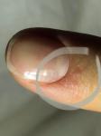 Отслоение и воспаление кожи вокруг ногтей несколько месяцев фото 2