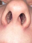 Воспаление носа фото 1