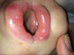 Болячки на губах и языке у ребёнка фото 2