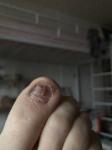 Прострел пальца и воспаление ногтя фото 2