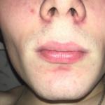 Покраснение вокруг носа и под нижней губой фото 3