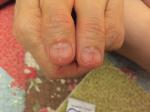 Трещины на ногтях больших пальцев фото 1