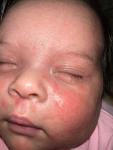 Сыпь на лице и голове у младенца фото 1