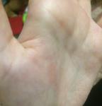 Сухие зудящие пятна на руках после лечения фото 1