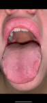 Болит горло, язык, воспалённые сосочки фото 3