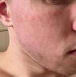 Сыпь на лице ужасное ощущение стягивания и шелушение фото 2