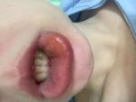 Опухла часть нижней губы фото 2