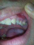 Покраснение после лечения зуба фото 1