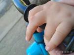 Шишка на пальце у ребенка, твердая фото 2