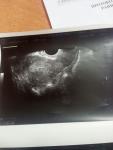 Трубная беременность фото 5