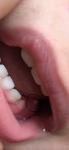 На месте жевательного зуба у ребёнка нарост в виде жгутика, фото 1