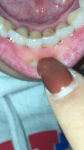 Шатаются зубы, воспаление Десны фото 2