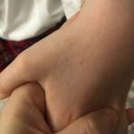 Сыпь на руке у ребёнка, чешется фото 3