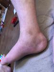 Перелом пятки опухшая нога фото 1