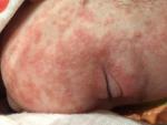 Цветение новорожденных или аллергия фото 2