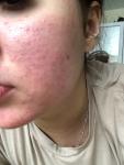 Аллергия, Сыпь на лице, аллергия, мб и прыщи, дерматит фото 2