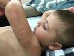 Аллергия или дерматит у ребенка фото 1