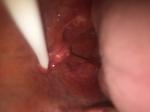 Опухоль нёбного язычка фото 3
