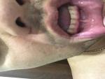 Лейкоплакия полости рта и губ фото 3