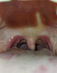 Воспаление горла, образование наростов на горле и языке фото 3