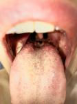 Воспаления у корня языка большие бугорки фото 1