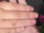 Поражённые ногти фото 1