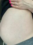 Сыпь на животе у беременной фото 1