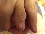 Трещины на ногтях больших пальцев фото 3
